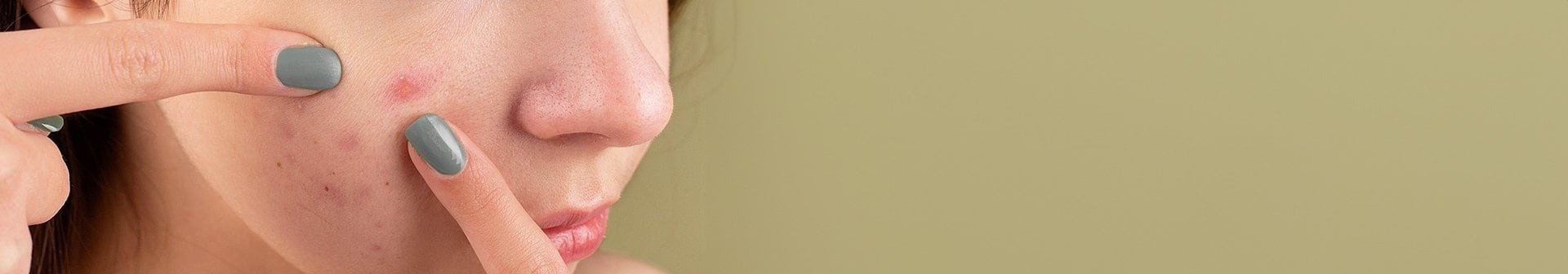 231130 blackheads hero pickel au