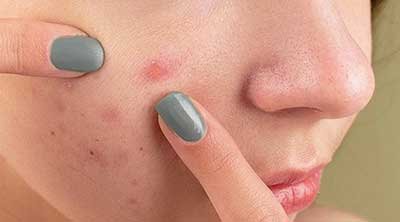 400x222 blackheads pickel