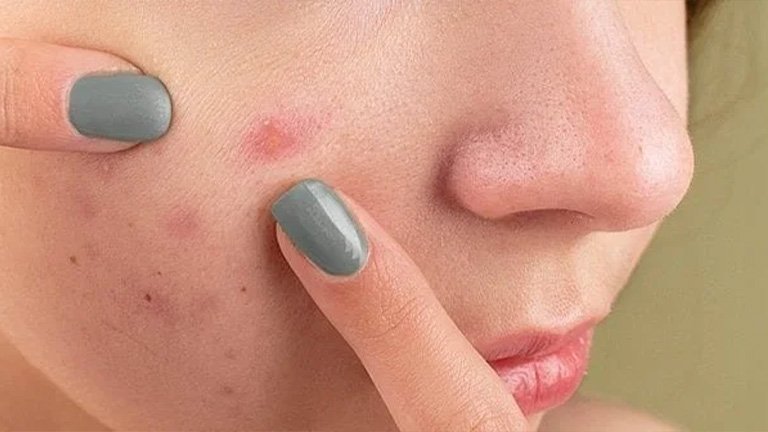 pimple patches 4