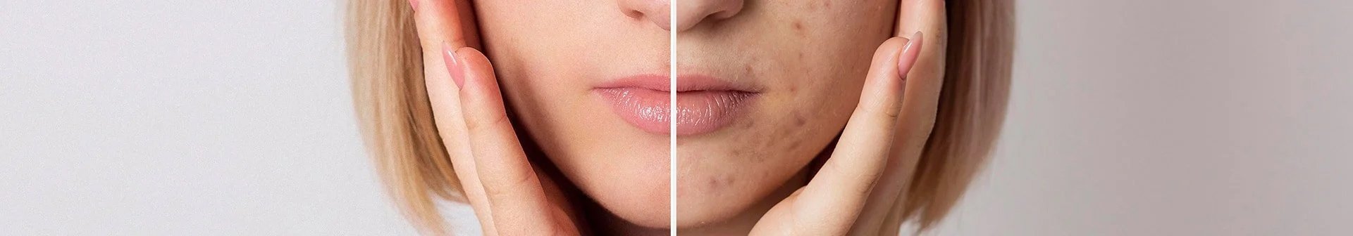 Hoe verklein je zichtbaar grove porien